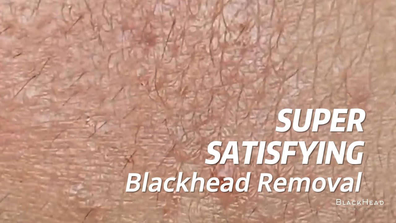 Super Satisfying BLACKHEAD REMOVAL YouTube