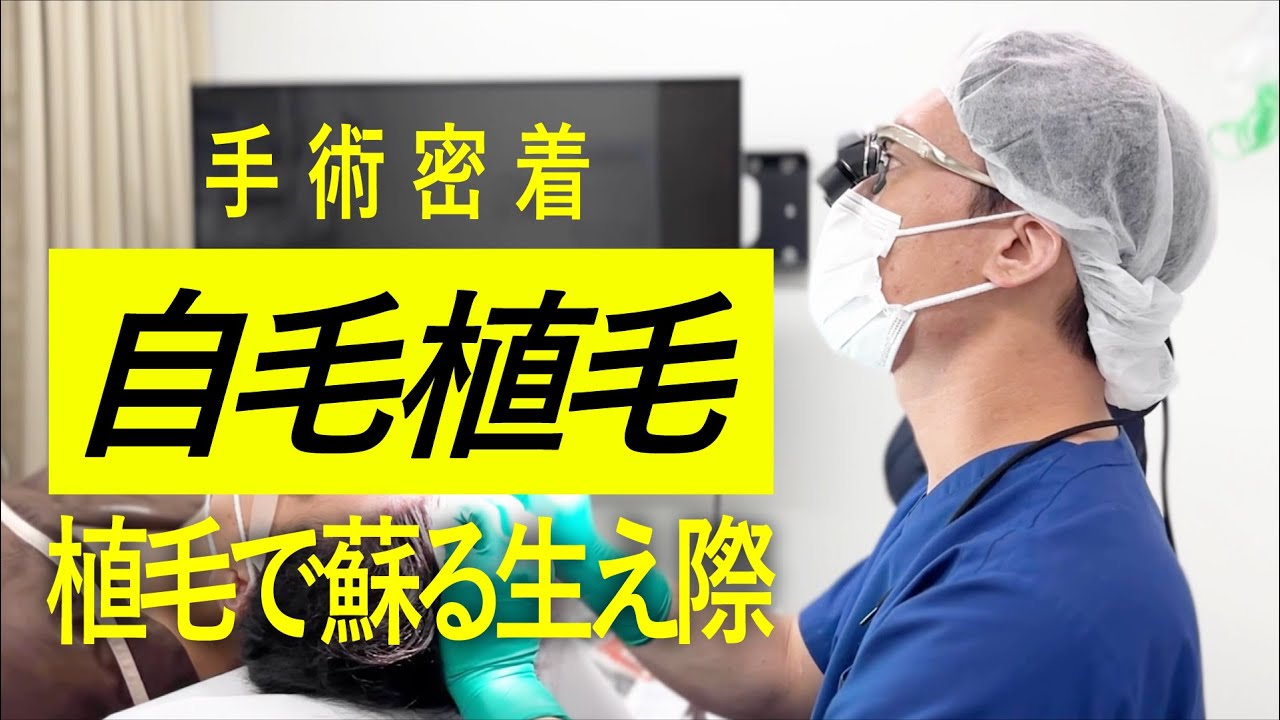 自毛植毛】後頭部を刈り上げないノンシェーブン植毛600グラフト【手術