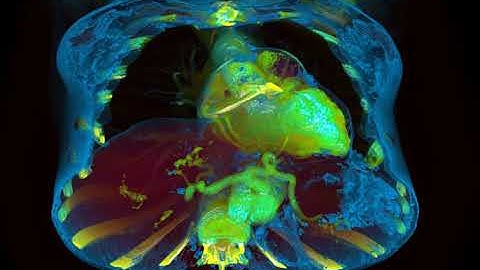 Cinematic rendering ct