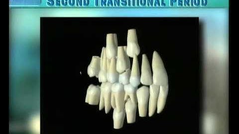 Clip 17: Transition of Canines and Premolars with Moderate Space