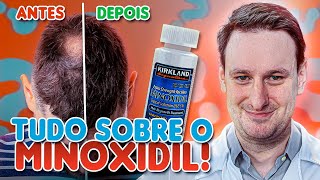 Tudo o que VOCÊ PRECISA SABER sobre o MINOXIDIL! Médico Explica