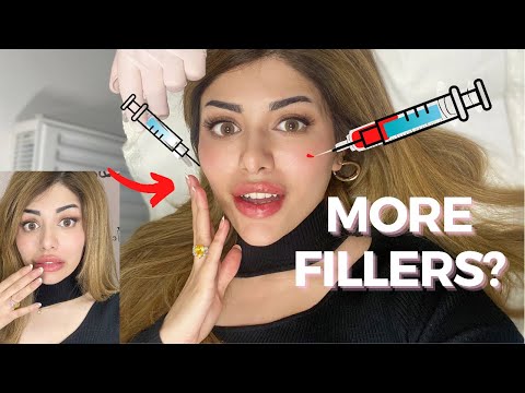 Face Fillers❗️Laugh Lines And cupids bow Before &amp; After(graphic &amp; detailed)