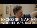 EXCESS SKIN AFTER BARIATRIC SURGERY | How to Handle Loose Skin after Extreme Weight Loss