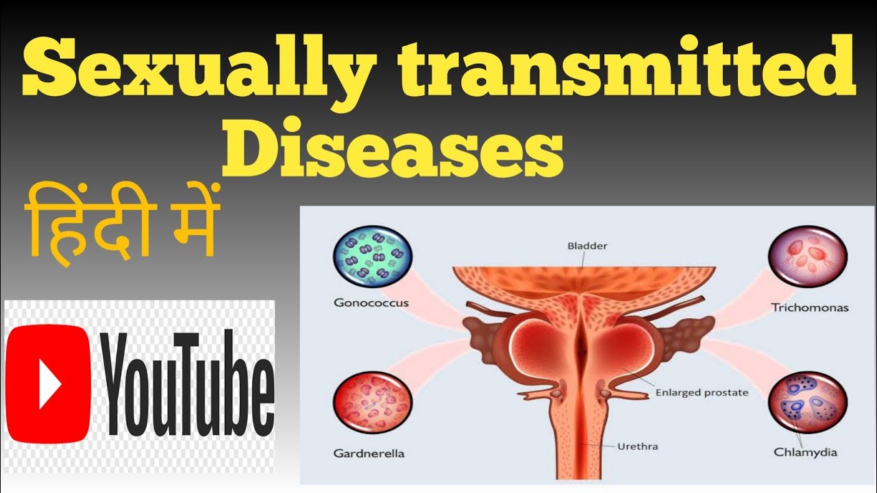 sexually transmitted diseases Causes ,Risk factors, sign and symptoms , Management in Hindi
