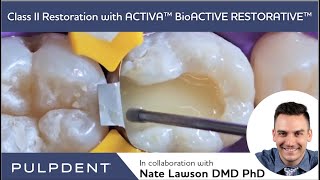 Class II Restoration with ACTIVA™ BioACTIVE RESTORATIVE™