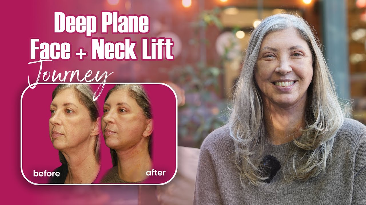 Day 3 After Awake Deep Plane Facelift & Neck Lift in Turkey | Best Facelift Surgery Clinic in Turkey