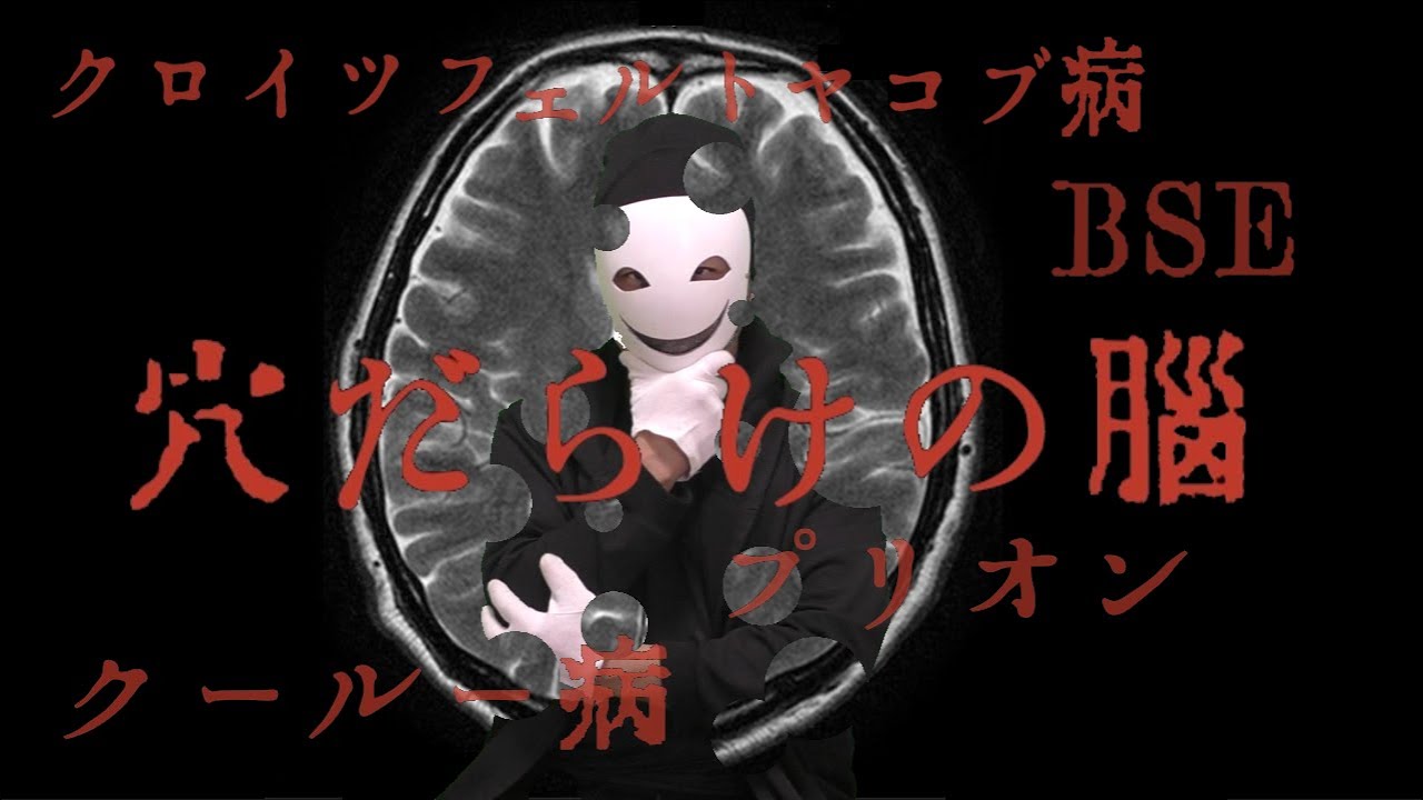 脳が穴だらけになる 異常プリオンの話 クロイツフェルト ヤコブ病 Youtube