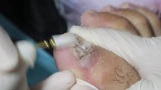Ep_3201 Foot nails skin removal 👣 ไปมาหลายที่ไม่หายครับ 😷 (This clip is from Thailand)