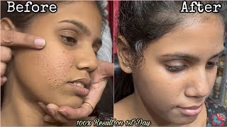 How To Remove Acne Scars and Blemishes From Face| 100% Effective Simple Skincare Routine With Result