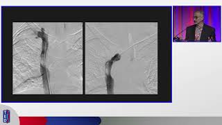 Thoracic Central Venous Occlusions Treatment Challenges Dr. Mahmood Razavi At Ted 2025