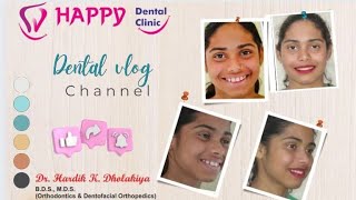 How we manage the case of congenitally missing lateral incisors. #braces #smile #invisalign #dentist