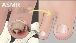 Asmr Nail Treatment, Ingrown Toenail Treatment Animation