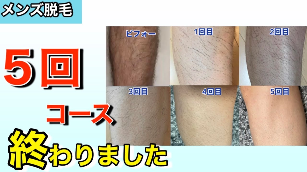 医療 脱毛 5 回 効果