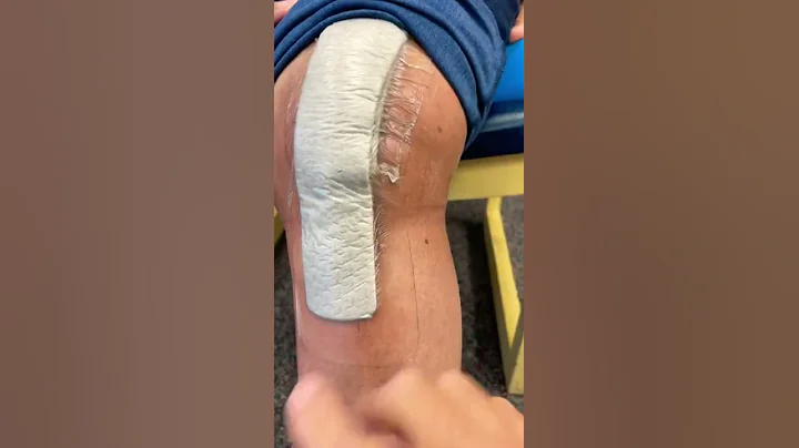 10 days post op knee replacement