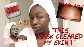 How I Cleared Tiny Bumps On My Face /Super Textured Skin / Fungal Acne | TheOfficialTyraRenee