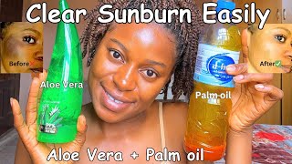 The most effective SUNBURN remedy in the World💯 How to clear sunburn & facial redness