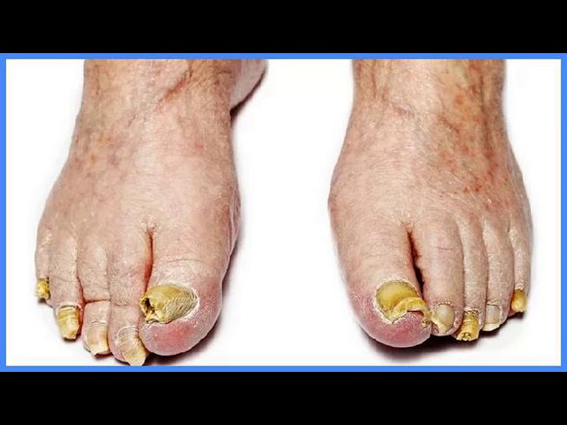 Средство От Грибка Ногтей На Ногах Фундизол