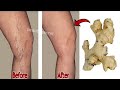 Say goodbye to varicose veins and joint pain with only 2 natural ingredients, 100%effective