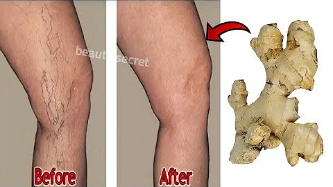 Say goodbye to varicose veins and joint pain with only 2 natural ingredients, 100%effective