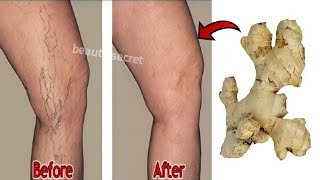 Say goodbye to varicose veins and joint pain with only 2 natural ingredients, 100%effective screenshot 1