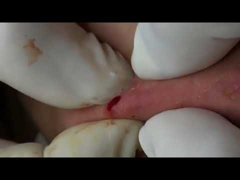 (AMAZING) !!! BEST BLACKHEAD REMOVE AND CYSTIC  REMOVE ON FACE (PART )