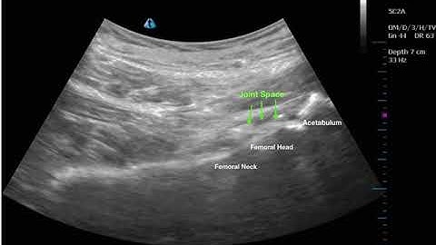 Ultrasound guided stem cell  Hip Injection