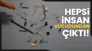 Hastaların Soluk Ve Yemek Borusundan Çivi, Jeton, Raptiye, Vida, Tel Toka Çıktı