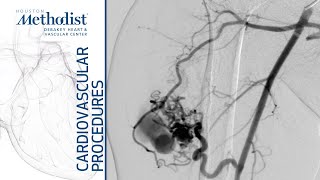 Onyx Embolization of Arteriovenous Malformation of Right Upper Arm (A. Lumsden, MD, M. Zubair, MD)