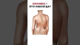 Секреты СКОЛИОЗА - как выправить ПОЗВОНОЧНИК? #меднавигатор #сколиоз #позвоночник