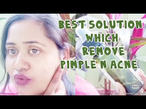 pimple or acne se chutkara pane ka best tarika 100%works - YouTube