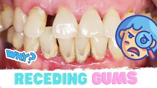 Gum Recession | Receding Gums Causes & Treatment