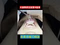 犬歯間保定装置の装着│How to directly bond Lingual Fixed Retainer|歯列矯正│#shorts