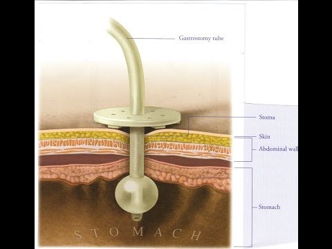 Γαστροστομία   Πως σταθεροποιείται