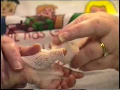 ABC&rsquo;s Hand Wrapping Technique (Epidermolysis Bullosa)