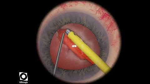 EyeSi CAT B Phaco Divide and Conquer, Level 3 (sculpting performed, crack into two halves)