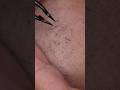 064 I cleaned it up.#tweezers #hairremoval #毛抜き
