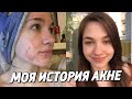 МОЯ ИСТОРИЯ АКНЕ | ПРЫЩИ