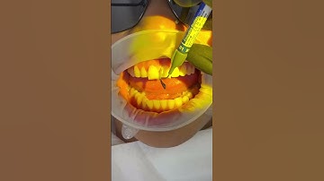 Dr. Josh composite bonding in action 😍👏 #cosmeticdentistry