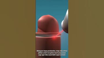 Animasi Sunat laser, Sakit tak berdarah metode Electric Cauter Circumcision