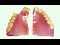 How To Fix Cracked Dentures At Home