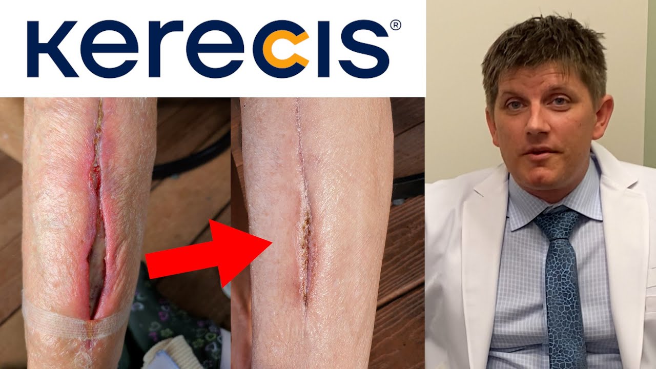 Dr. Doug Toole Preventing Amputation with Kerecis Fish Skin Grafts
