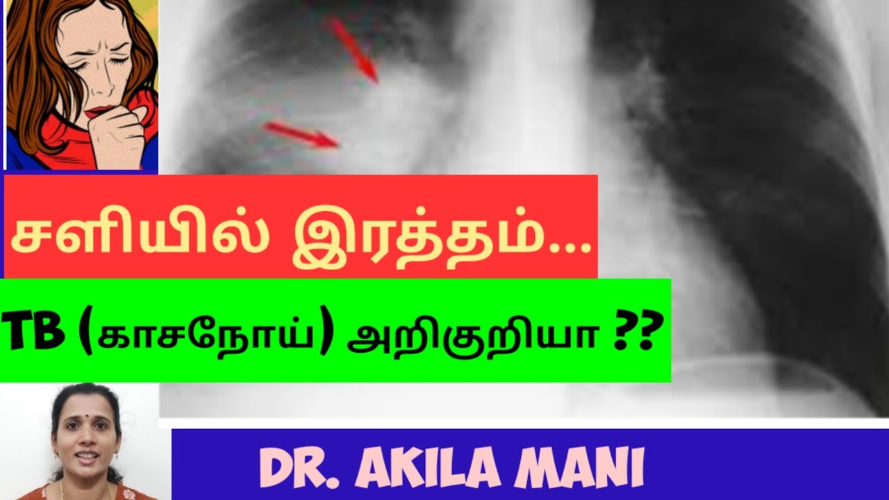 சளியில் இரத்தம் வந்தால். blood in sputum. காசநோய் அறிகுறிகள். tb. sputum test. TB day. Dr.akilamani