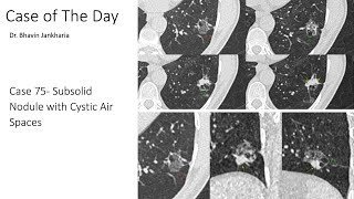 Case of the Day - 075 - 2025 07 24 - Subsolid Nodule with Cystic Air Spaces