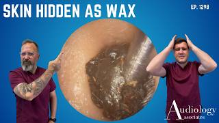 Not Wax, It's Skin – Then a Rock-Hard Wax Plug – EP1298