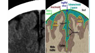 Basics of brain CT scan part I