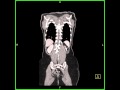 Miscellaneouswhole body studywhole body ct scan view as interactive display in the coronal plane