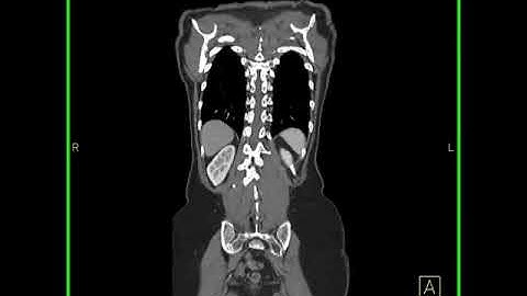 Miscellaneous:Whole body study:Whole body CT scan view as interactive display in the coronal plane.