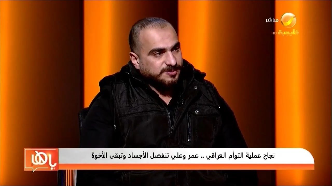 نجاح عملية التوأم العراقي .. عمر وعلي تنفصل الأجساد وتبقى الأخوة