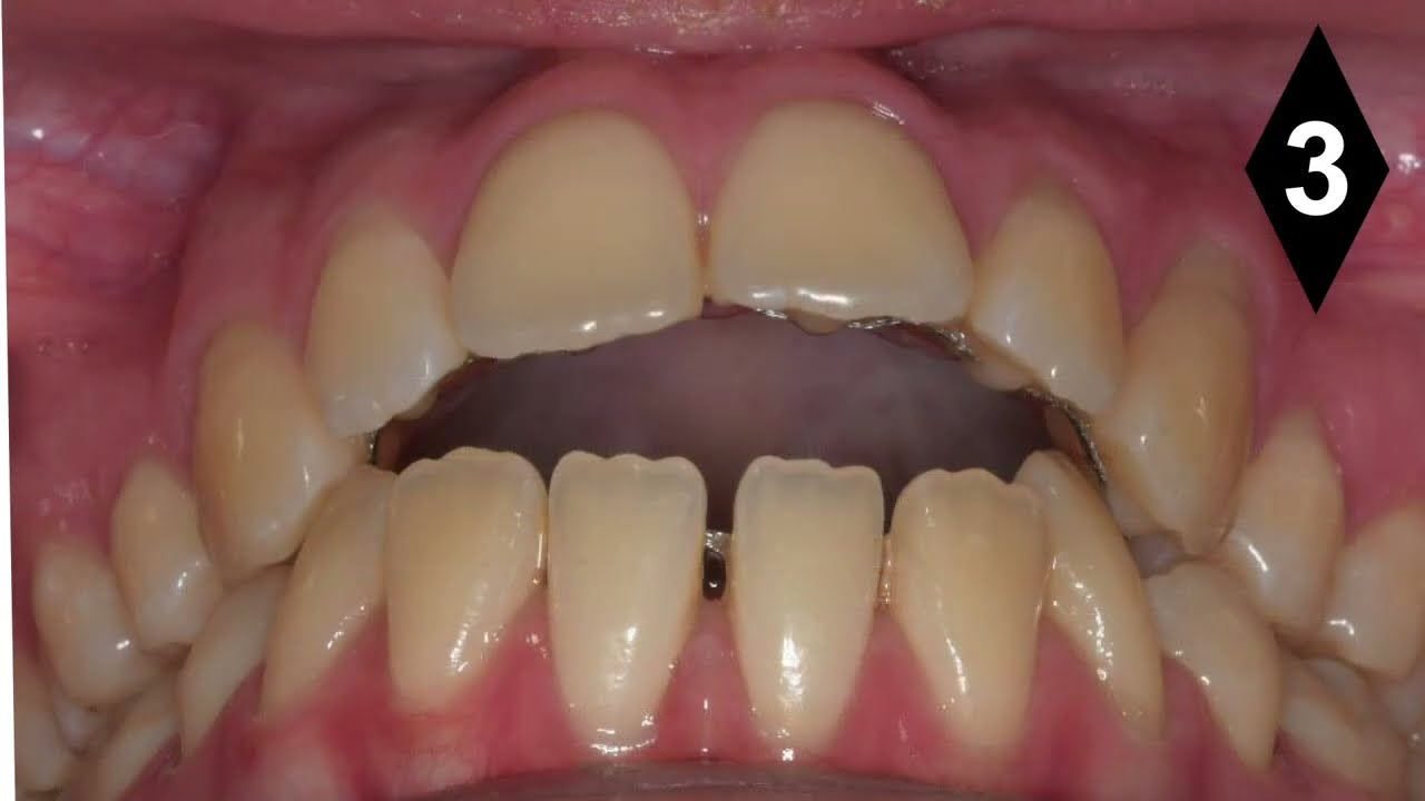 Mordida Abierta (Open Bite) Ortodoncia Plástica  (Invisalign) Sin Cirugía