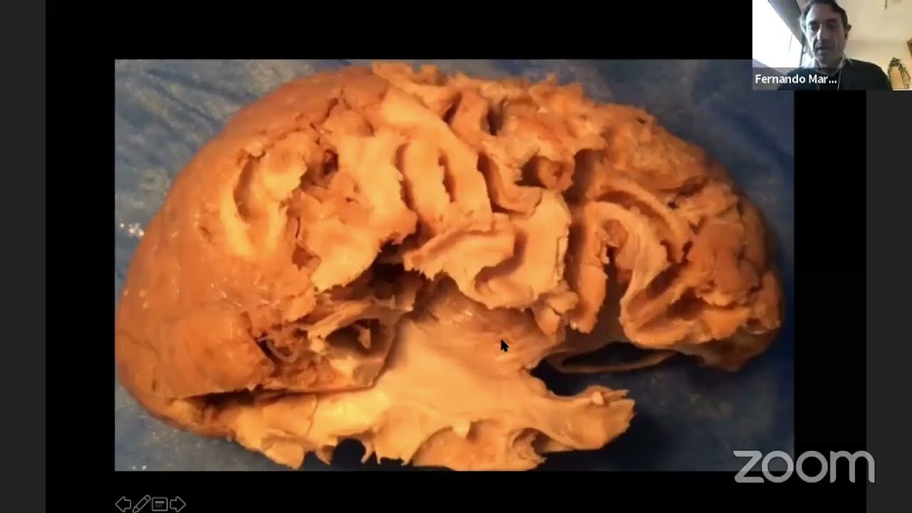 Доктор Фернандо Мартинес — Анатомия белого вещества и радиология.